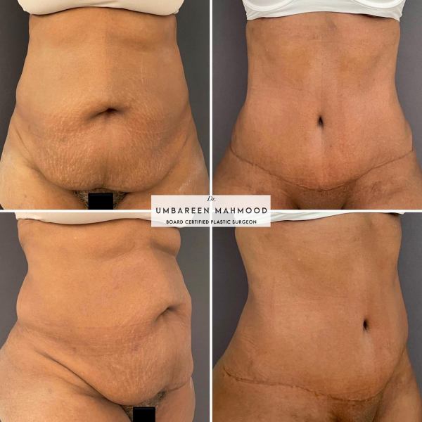 Abdominoplasty-liposuction