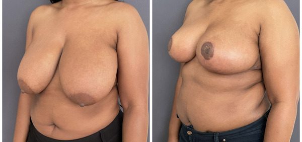Before-AFter-Breast-Reduction-20-1