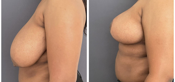 Before-AFter-Breast-Reduction-20-2