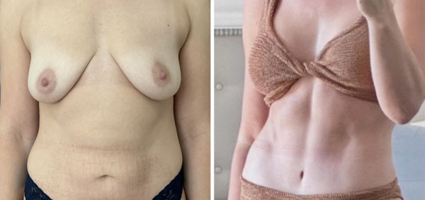 Before-after-mommy-makeover-nyc-10