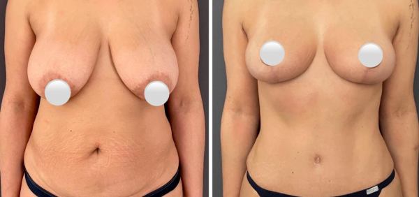 Mommy-makeover-breast-lift-abdominoplasty-liposuction