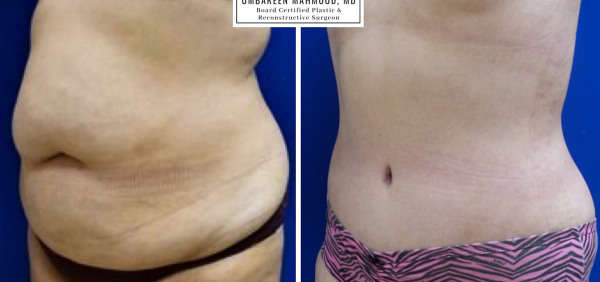 abdominoplasty-before-after-1
