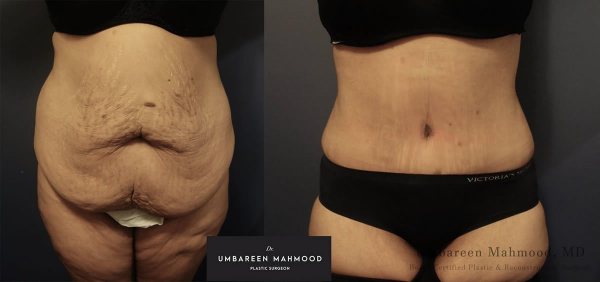 abdominoplasty-before-after-2