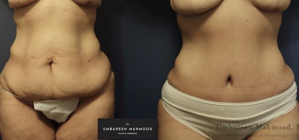 abdominoplasty-before-after-3