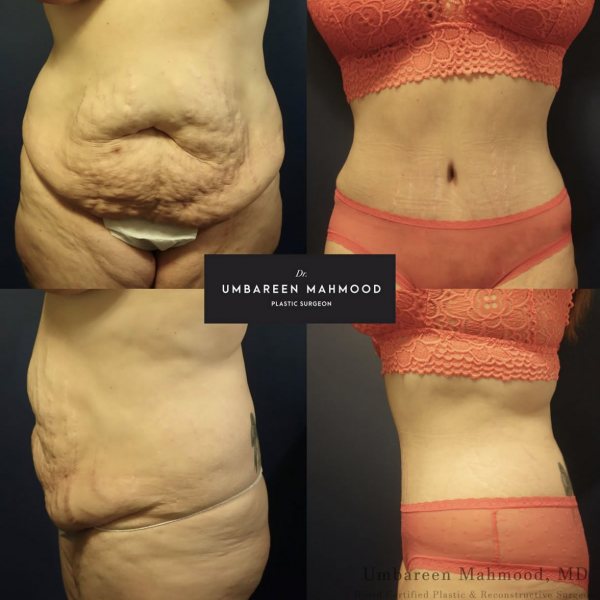 abdominoplasty-before-after-4
