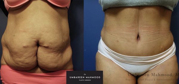 abdominoplasty-before-after-5