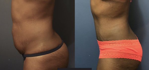 abdominoplasty-before-after-6