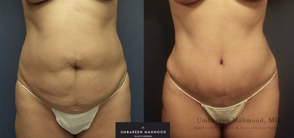 abdominoplasty-before-after-7