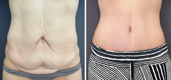 abdominoplasty-before-after-p11