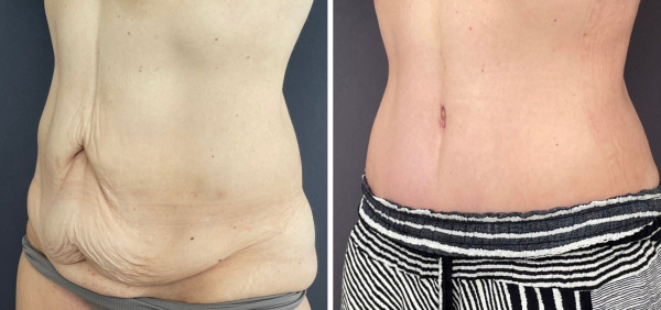 abdominoplasty-before-after-p12