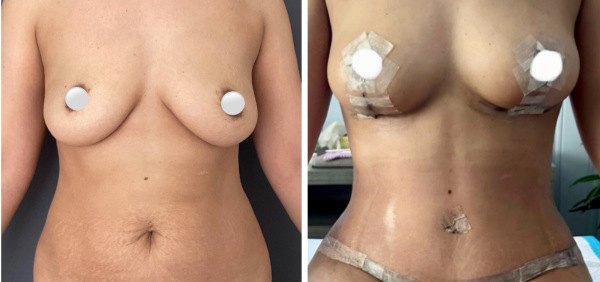 before-after-mommy-makeover-abdominoplasty-breast-lift