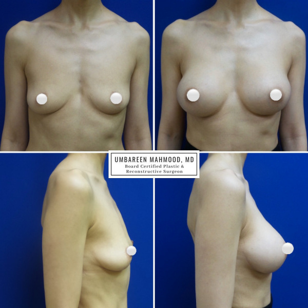 breast-augmentation-before-after-1