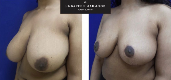 breast-reduction-before-after-1
