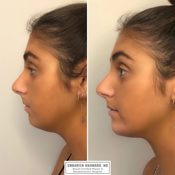 chin-filler-before-after-1