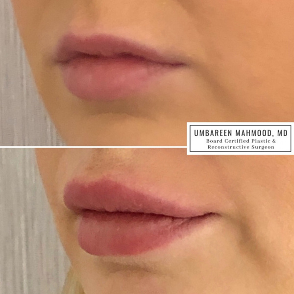 lip-augmentationbefore-after-3