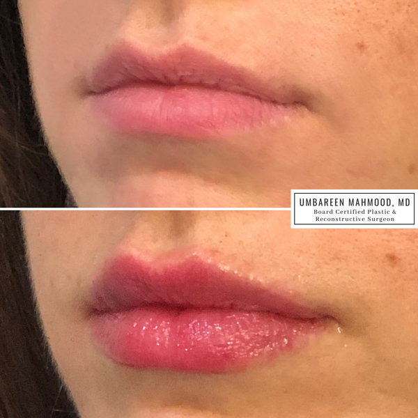 lip-filler-before-after-1
