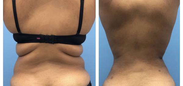 liposuction-before-after-1