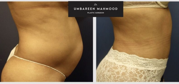 liposuction-before-after-2