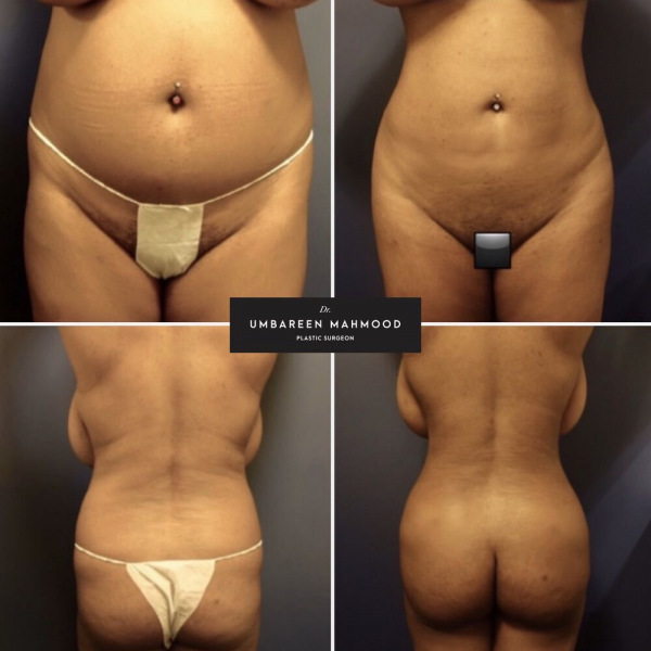 liposuction-before-after-3