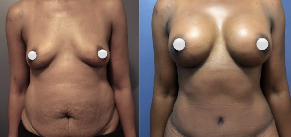 mommy-makeover-before-after-1