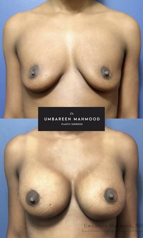 mommy-makeover-before-after-2