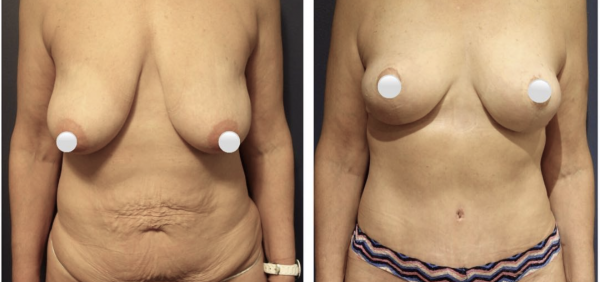 mommy-makeover-before-after-4