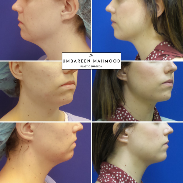 submental-liposuction-before-after-1