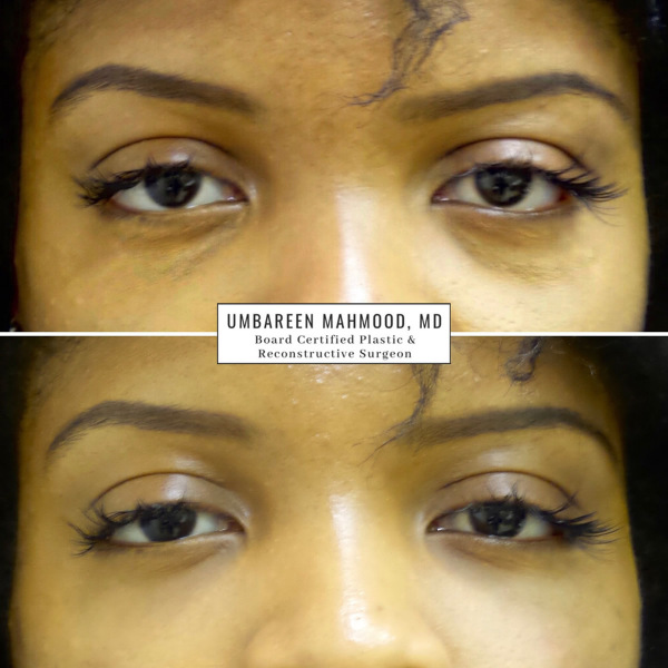 tear-troughs-before-after-1