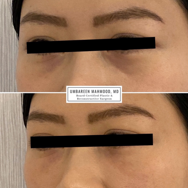 tear-troughs-before-after-5