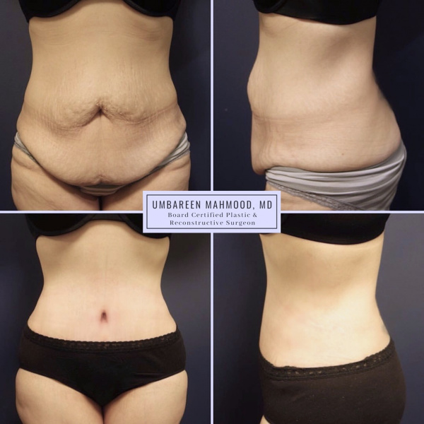 tummy-tuck-before-after-1